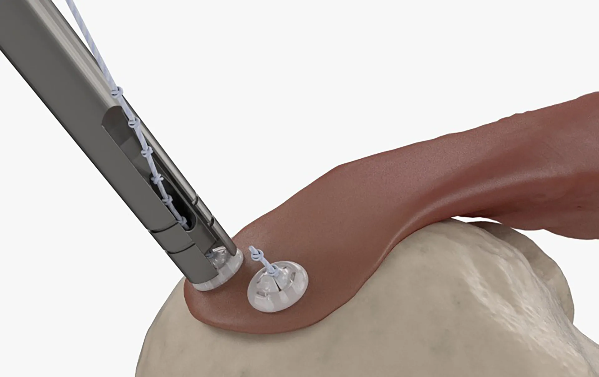 Cirugía Médica con botones quirúrgicos