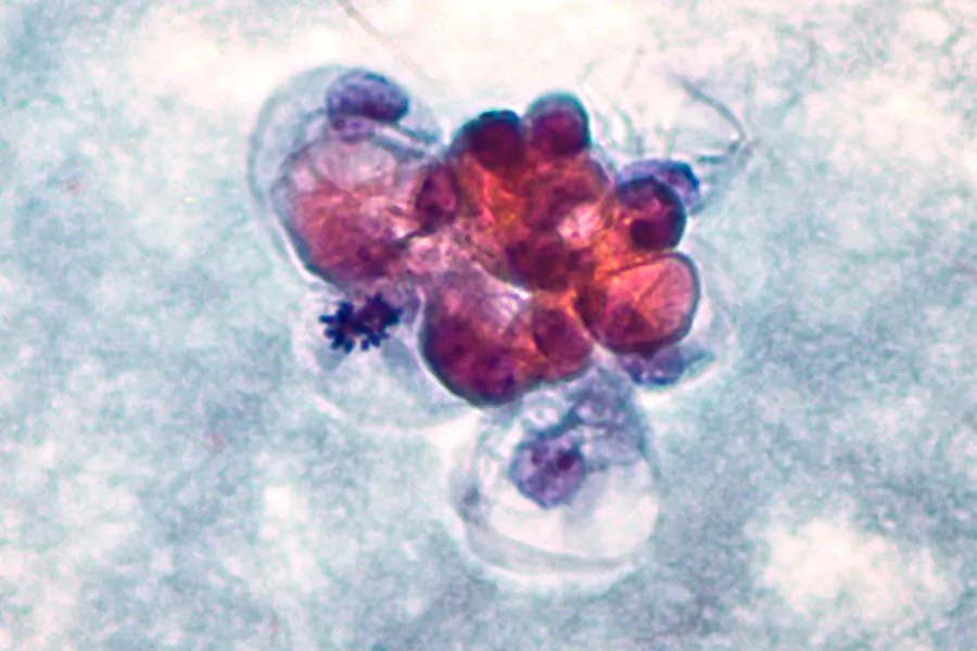 ilustración biomarcadores de cáncer de mama