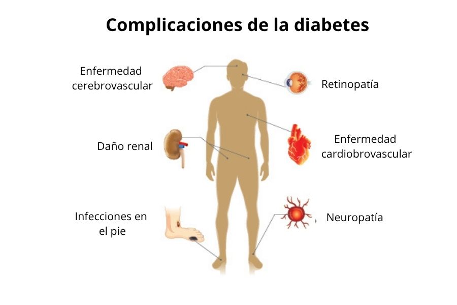 Infograf&iacute;a que muestra las principales complicaciones de la diabetes mellitus: enfermedad cerebrovascular, retinopat&iacute;a y ceguera, da&ntilde;o renal permanente, infarto al coraz&oacute;n, infecciones en el pie diab&eacute;tico y neuropat&iacute;a perif&eacute;rica, se&ntilde;aladas en distintas partes del cuerpo humano.