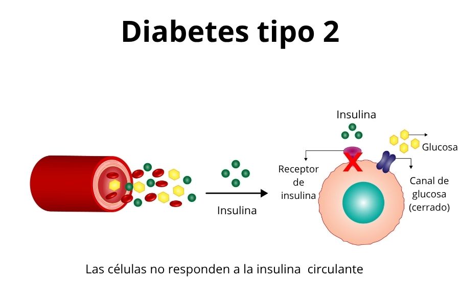 Infograf&iacute;a que muestra c&oacute;mo, en la diabetes tipo 2, la insulina no logra abrir los receptores de la c&eacute;lula, el canal de la glucosa permanece cerrado y la glucosa se queda en la sangre