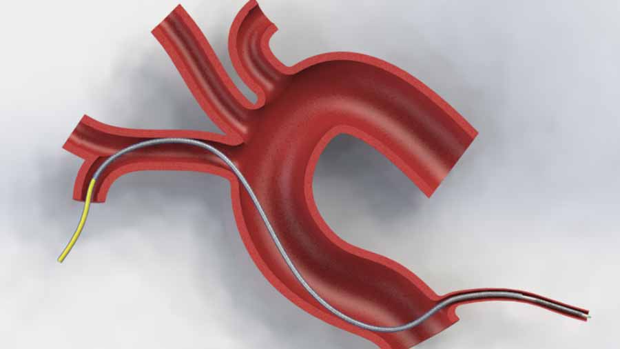 La falta de rigidez en los catéteres es el área de oportunidad que Ramsés con su empresa GSE Biomedical y la compañía Nanostent de Quebec buscarán innovar